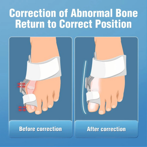 Novella™ Clinical Grade Toe Realignment & Correction System