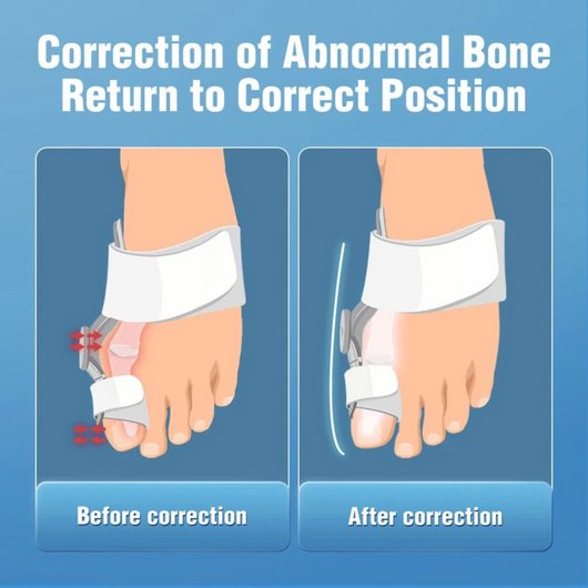 Novella™ Clinical Grade Toe Realignment & Correction System
