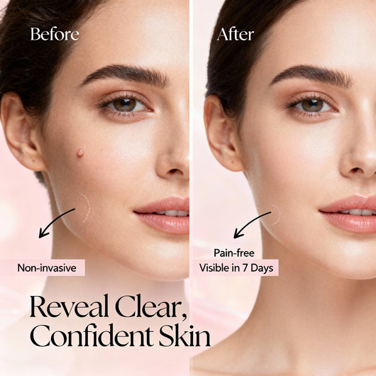 Novella™ Professional Skin Tag Remover